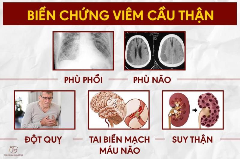 Biến chứng của viêm cầu thận