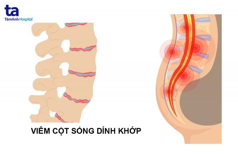 Viêm cột sống dính khớp