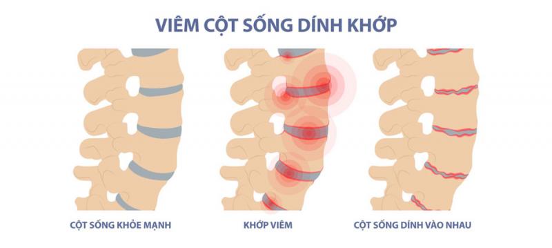 Viêm cột sống dính khớp