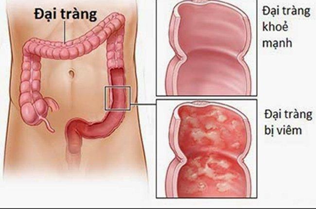 Viêm đại tràng giả mạc