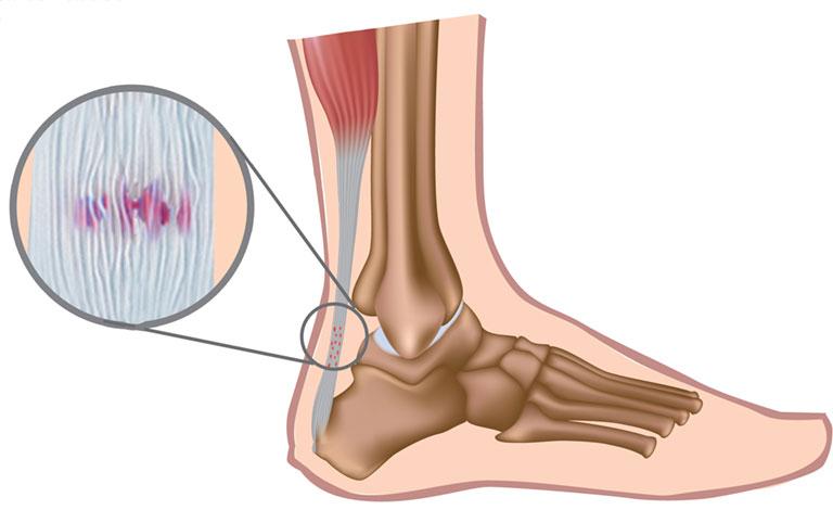 Viêm gân Achilles