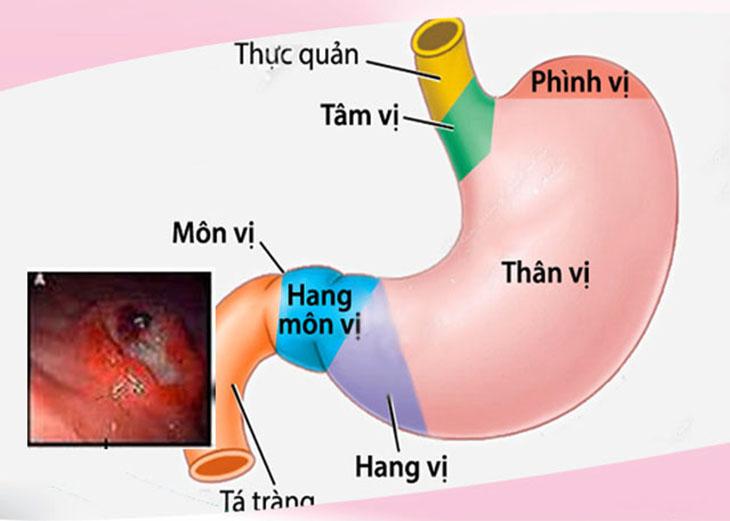 Viêm hang vị dạ dày