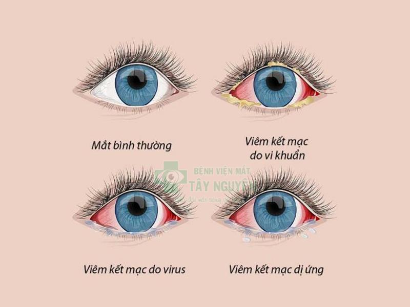 Bệnh viêm kết mạc