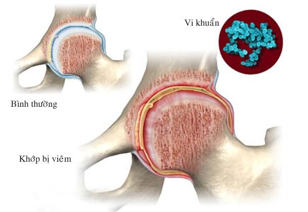 Viêm khớp nhiễm trùng