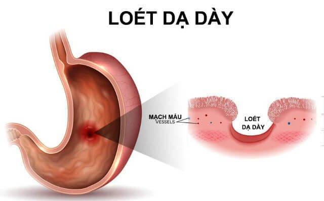 Viêm loét dạ dày do rượu