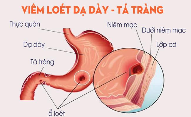 Viêm loét dạ dày tá tràng