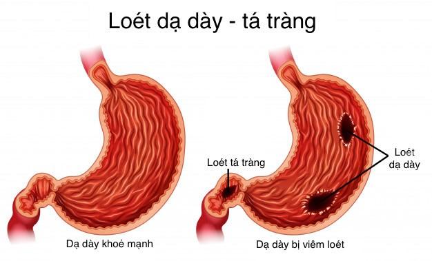 Viêm loét dạ dày tá tràng