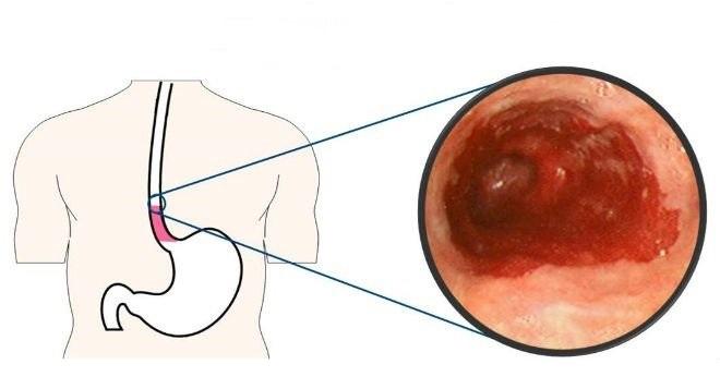 Viêm loét thực quản