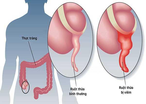 Viêm ruột thừa là gì?