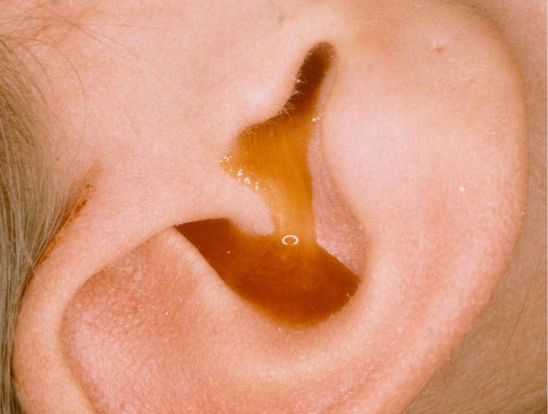 Bệnh viêm tai giữa ở trẻ
