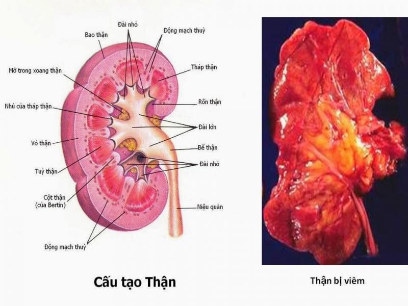 Thận bị viêm