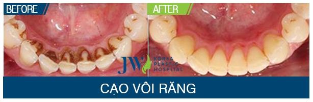 Viện Cấy Ghép Implant JW Hàn Quốc