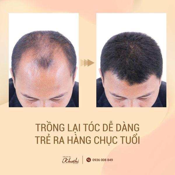 Cấy tóc nam  Giải pháp số 1 khắc phục tình trạng rụng tóc hói đầu