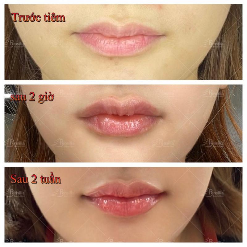 Tiêm filler nâng mũi - Viện Thẩm Mỹ Pensilia