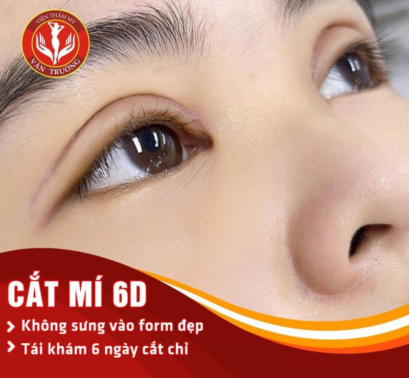 Trước khi cắt mí