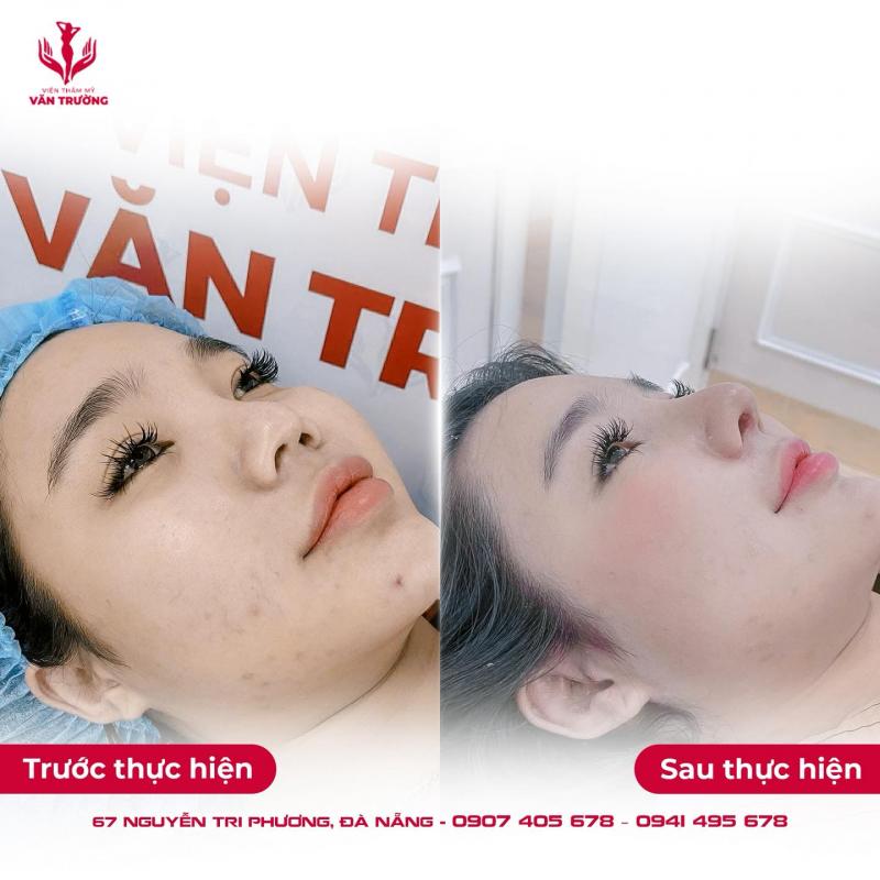Viện Thẩm Mỹ Văn Trường - Địa chỉ Tiêm Filler, Botox Đáng Tin Cậy Tại Đà Nẵng