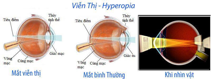 Mắt viễn thị so với mắt bình thường khi nhìn vật