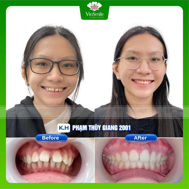 VinSmile Tỏa Sáng Nụ Cười Việt