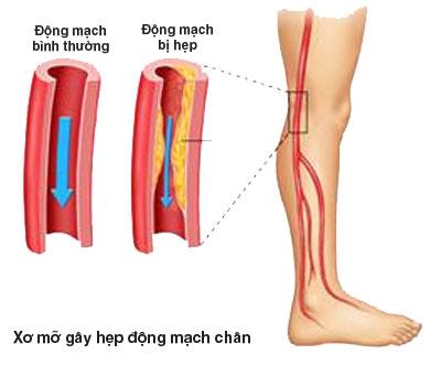 Xơ cứng động mạch