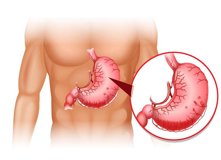 Xuất huyết dạ dày là gì?