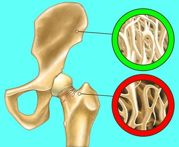 Xương sẽ trở nên chắc khỏe hơn